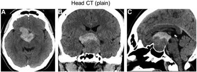 Case report: Giant pituitary neuroendocrine tumor presented along with acute visual loss due to pituitary apoplexy after receiving COVID-19 vaccination